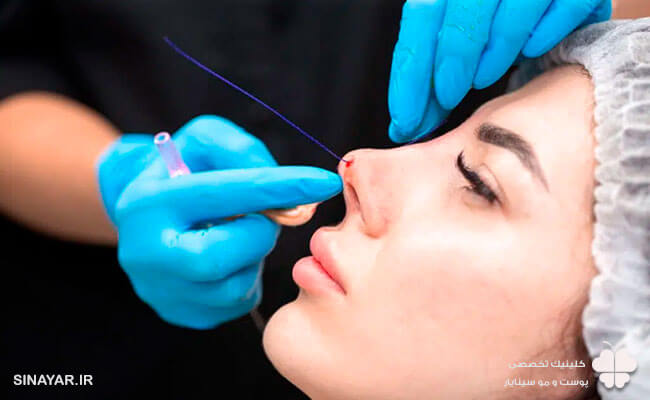 ماندگاری لیفت بینی با نخ چقدر است 