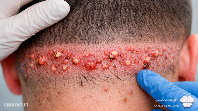 جوش در ناحیه برداشت مو