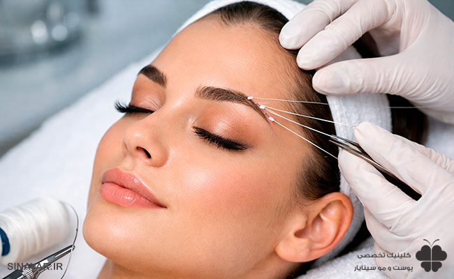 لیفت ابرو با نخ دائم