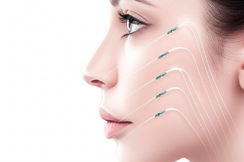 لیفت بینی با نخ