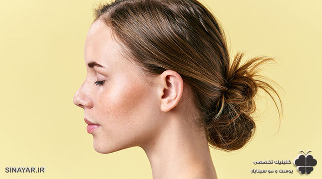 هزینه لیفت بینی با نخ در اصفهان