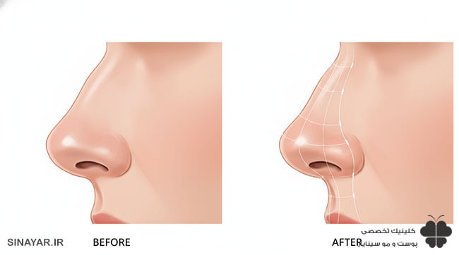 دکتر لیفت بینی با نخ در اصفهان