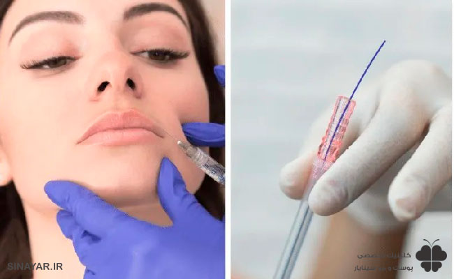 بررسی نحوه انجام لیفت صورت با نخ در برابر تزریق ژل