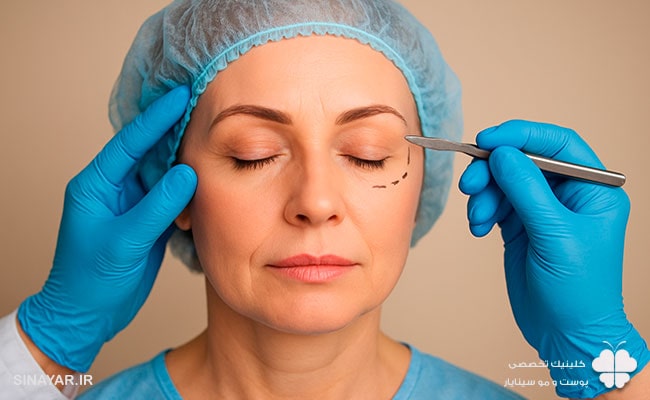 لیفت شقیقه با نخ یا جراحی؛ کدام ماندگاری و نتیجه بهتری دارد؟