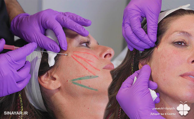 لیفت شقیقه با نخ یا جراحی؛ کدام ماندگاری و نتیجه بهتری دارد؟