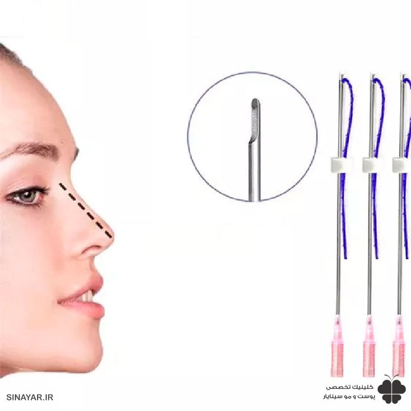 لیفت نخ با بینی