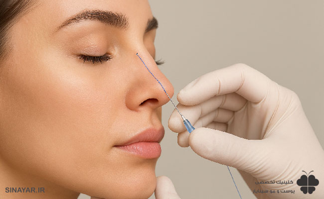 لیفت بینی با نخ