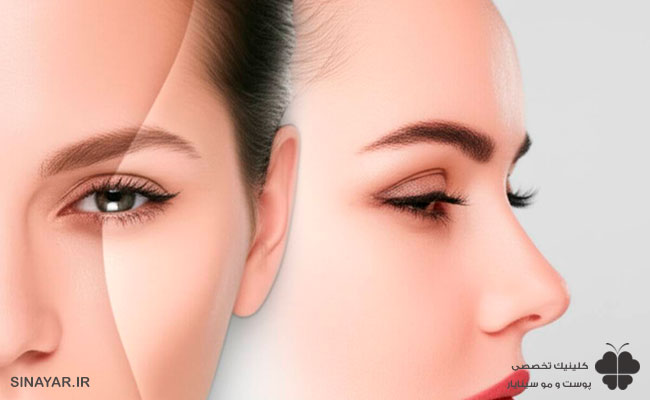 لیفت شقیقه با نخ یا جراحی؛ کدام ماندگاری و نتیجه بهتری دارد؟