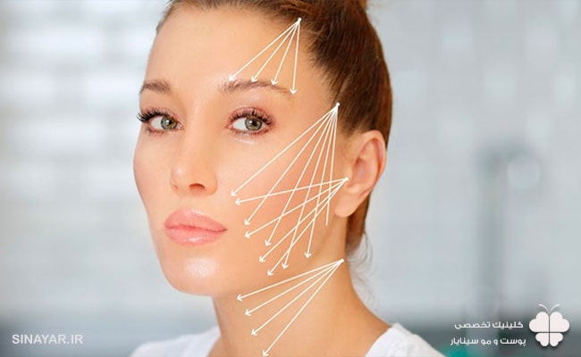 هزینه لیفت شقیقه با نخ در اصفهان (1404)