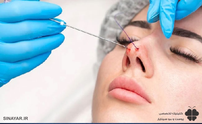 کاربردهای لیفت بینی با نخ