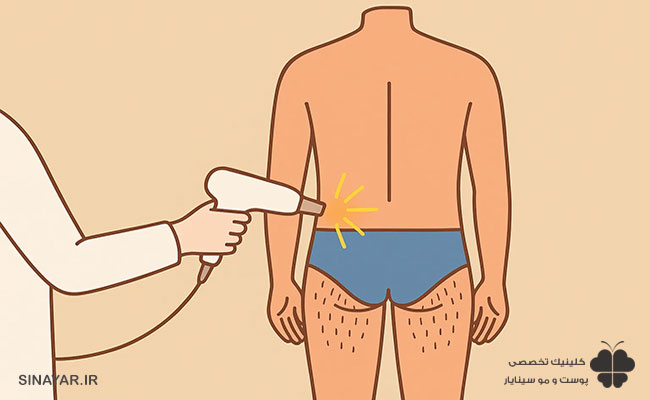 عوارض لیزر مایو آقایان