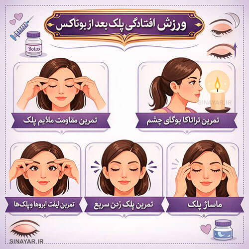 ورزش افتادگی پلک بعد از بوتاکس
