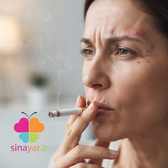 سیگار کشیدن بعد از تزریق بوتاکس