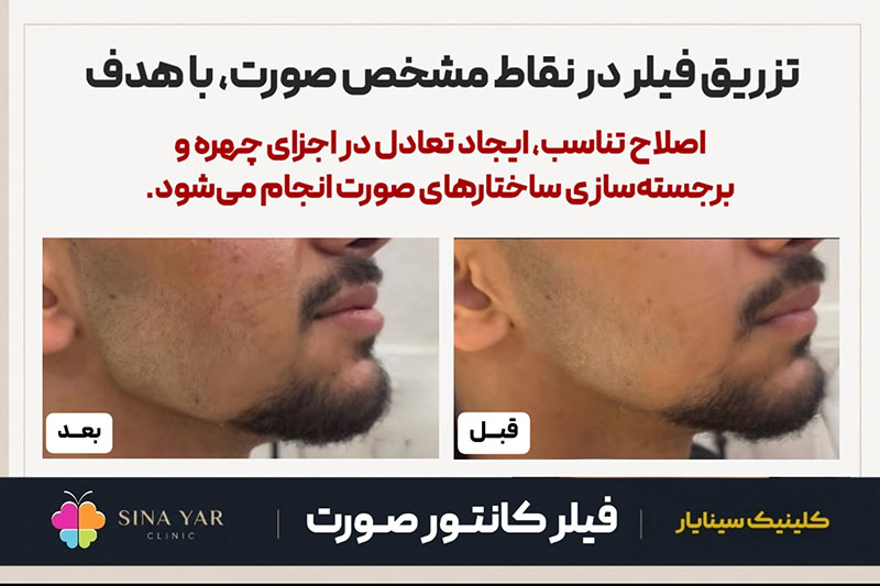 بهترین پزشک تزریق فیلر در اصفهان