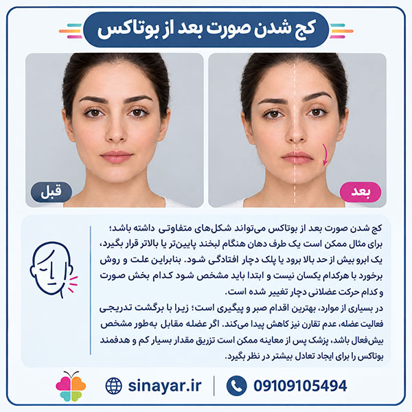 کج شدن صورت بعد از بوتاکس