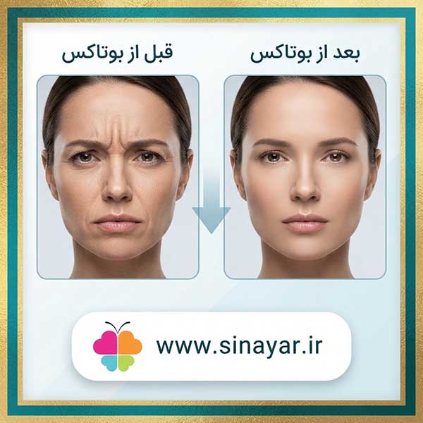 عکس قبل و بعد بوتاکس خط اخم