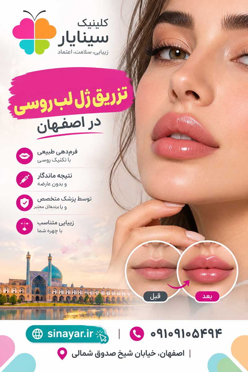 بهترین دکتر تزریق ژل لب روسی در اصفهان